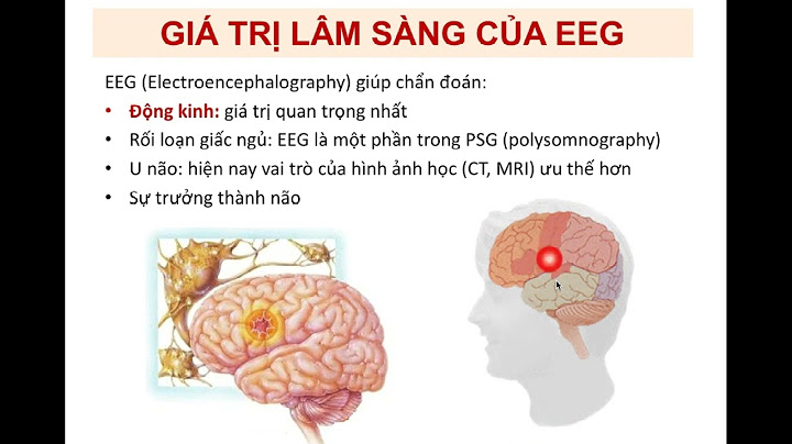 Điện não đồ giá bao nhiêu tiền