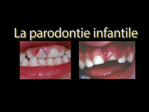 la #parodontie infantile