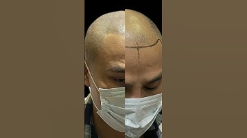 Xăm tóc thay đổi như thế nào #scalp #xămtóc