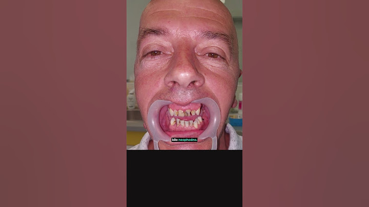 Hteo da izvadi sve zube, sad ima blistav osmeh