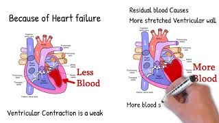 Pulsus alternans  - alternation of one strong and one weak beat.