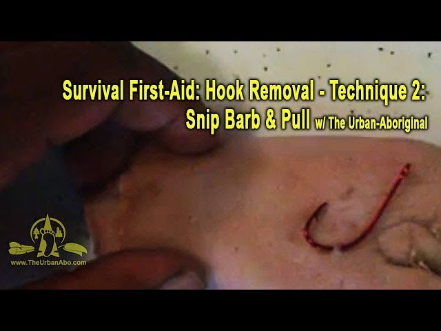 First-Aid: Hook Removal - Technique 2: Snip Barb & Pull w/ The  Urban-Aboriginal 