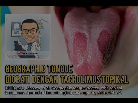 Video: Glossitis Catarrhal Pada Kanak-kanak: Gejala, Sebab, Rawatan