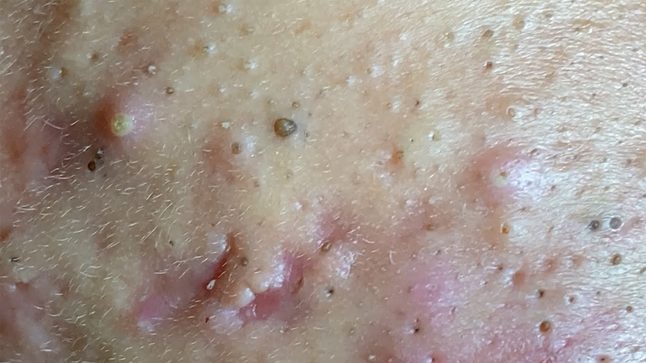 Nose Blackhead and Some Others