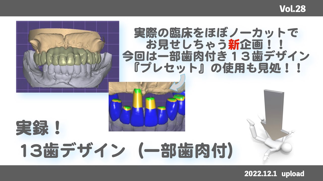 【exocad】実録！13歯デザイン（一部歯肉付）