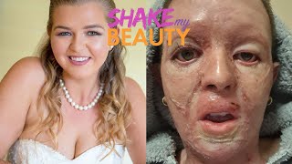 I Fell FaceFirst Into A Camp Fire | SHAKE MY BEAUTY