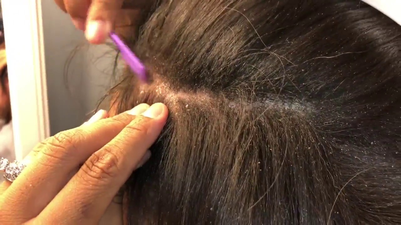 scalp psoriasis removal videos)