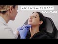 LIP AND CHIN FILLER: MY EXPERIENCE, FOOTAGE + MORE