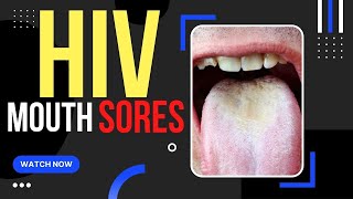 When Do Hiv Mouth Sores Appear ? screenshot 1