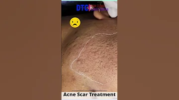 Dr. Rohit Goel Acne scar Reduction