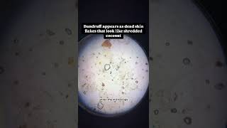 Microscopic View Of Dandruff A Closer Look At Scalp Flakes