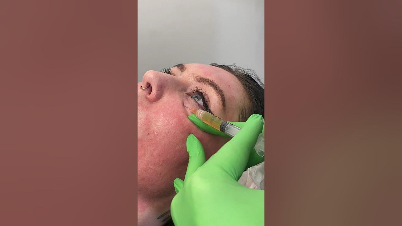 The 20-Second Trick For Lip Botox Wiki thumbnail