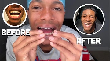 How I Fixed My Gap! Part 1 (Byte Review)