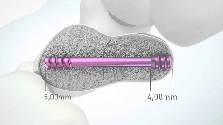 HBS 2 Headless bone screw von KLS Martin