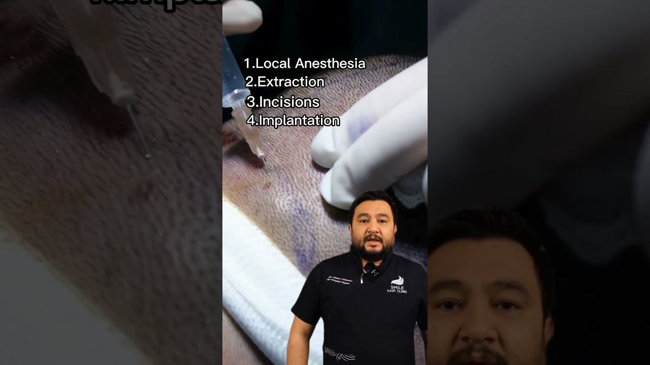 HAIR TRANSPLANT SURGERY STEPS HOW IS FUE APPLIED 
