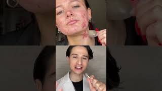 Pimple Patch Secret. #dermreacts #acne #skincare