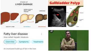 Fatty liver Grade 2 Gall Bladder polyp & Chronic Acidity Cured by Dr Arpit Chopra Modern Homoeopathy