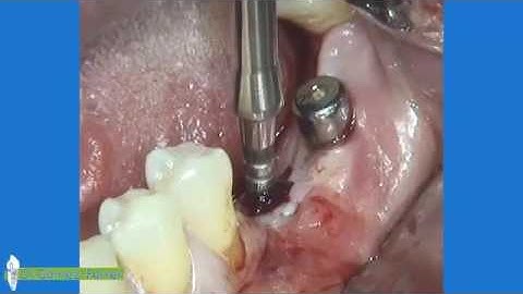 Dr Gomez Ferrer_Mandibular split crest with Magnetic Mallet