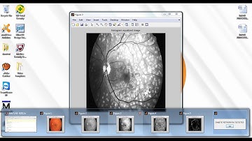 diabetic retinopathy detection using matlab code||final year ece projects at bangalore