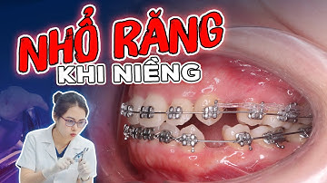 Nhổ Răng Khi Niềng: Cảnh Báo "Cụp Răng" Nếu Nhổ Răng Không Kiểm Soát, Xem Ngay Cách Khắc Phục