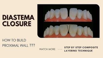 Diastema closure | how to build Proximal wall | Dental education | Your Dentist #directcomposite