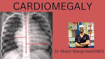 Cardiomegaly on Chest X ray !! How to Measure Cardiothoracic Ratio(CTR)