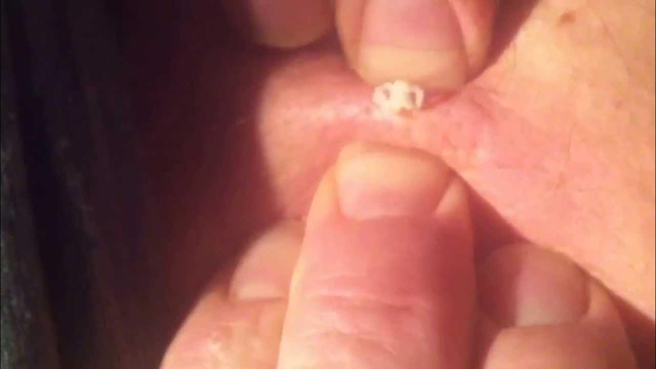 massive zit extreme explosion pimple YouTube