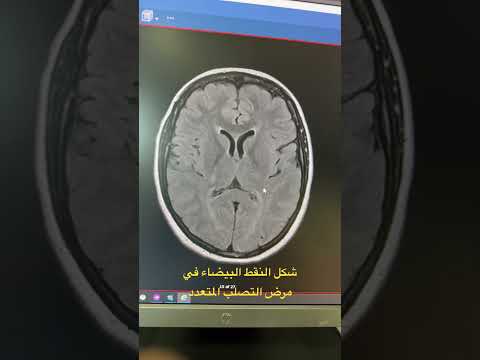 أشكال النقط البيضاء في مرض التصلب المتعدد التصلب اللويحي أعصاب الدماغ