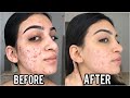 One week of cinnamon mask on my face to get rid of acne shocking results