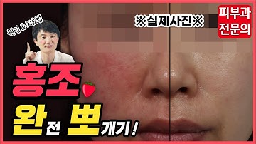 (sub)안면홍조 원인과 치료방법? 얼굴 붉어지는 이유 알고계신가요?