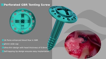 Perforated GBR Tenting Screw – Boost Blood Flow & Bone Regeneration | Clinical Demo