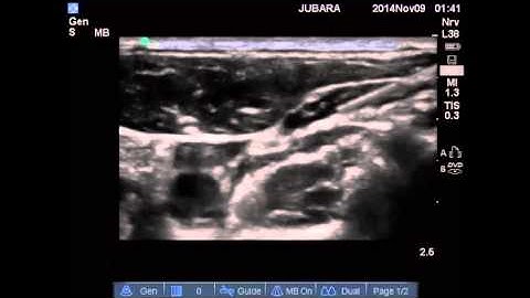 INTERMEDIATE CERVICAL +SUPERFICIAL CERVICAL PLEXUS BLOCK