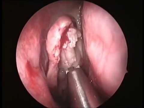 Thesis on functional endoscopic sinus surgery fess