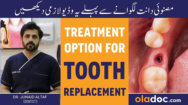 Missing Teeth Solution - Dant Tutne Ka Ilaj - Dental Implants - Best Option For Tooth Replacement