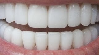 How To Have Natural White Teeth in less than 5 minutes