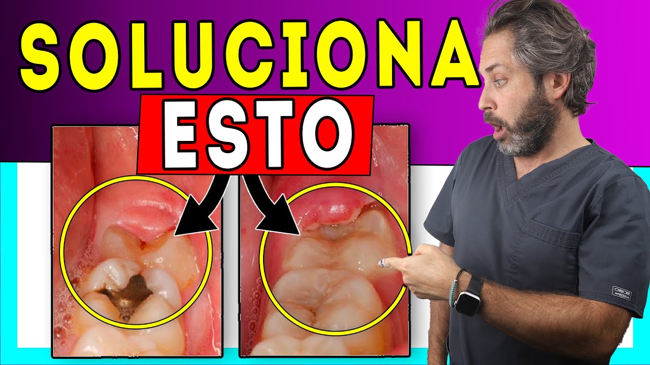 ?Encía ????????? Muela del Juicio -?Tratamiento de  ??????????????? del tercer molar (?????????? ?) -  YouTube