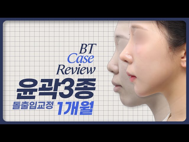 돌출입교정, 케이스 리뷰 ㅣ비티성형외과