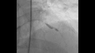 balloon undilatable coronary lesion, role of rotatripsy