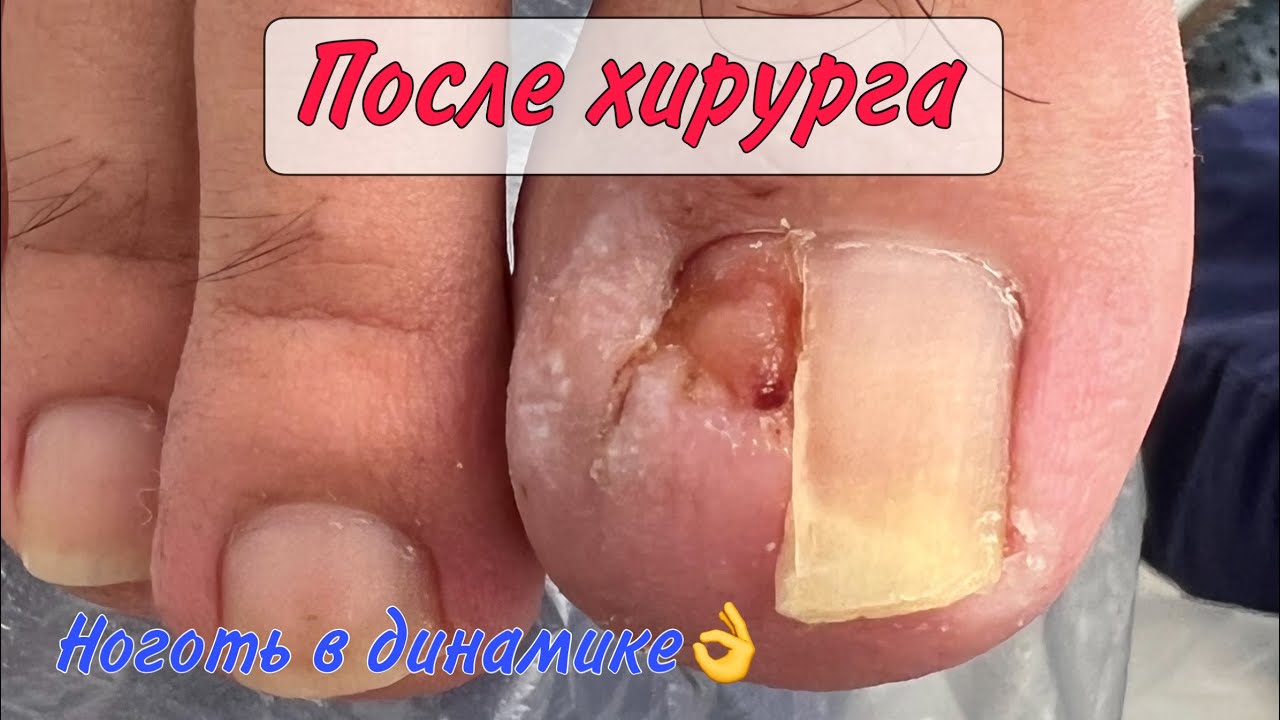 Ноготь после хирурга / вросший ноготь / подолог в москве - YouTube
