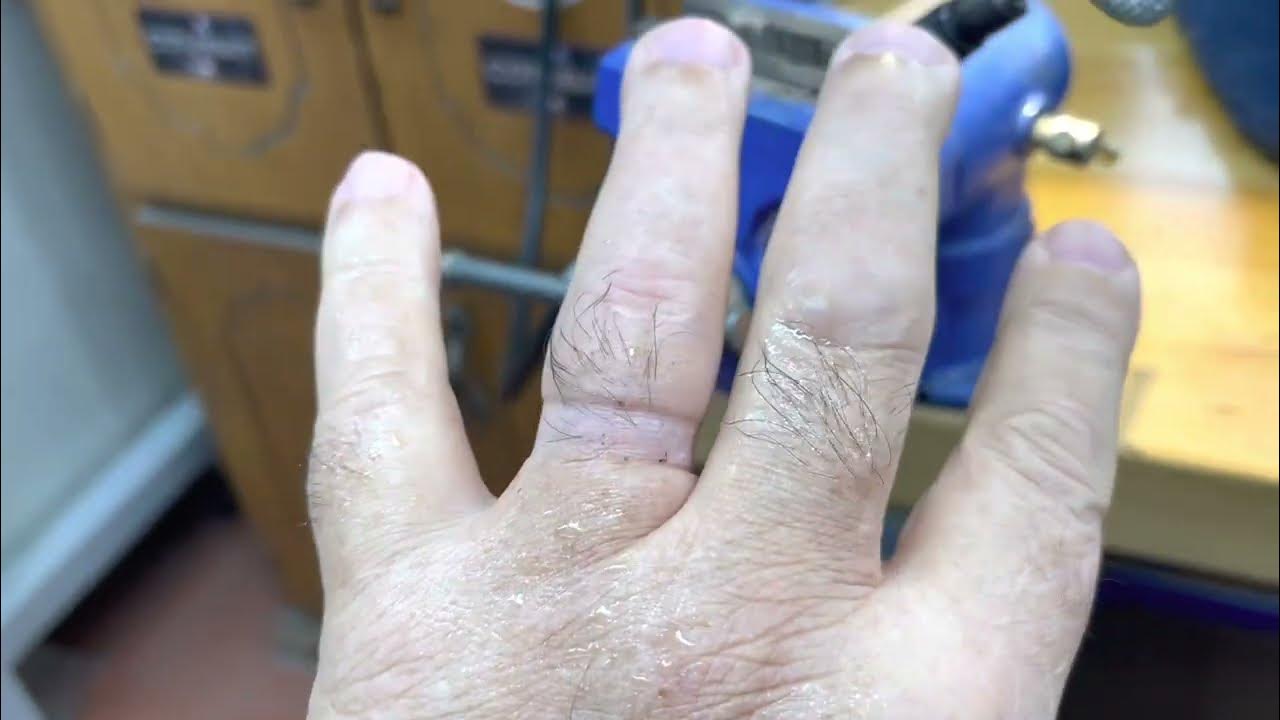 Cutting a ring off my finger YouTube