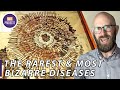 Some of the World's Rarest and Most Bizarre Diseases