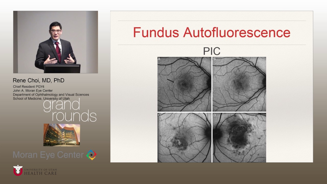 http://clinicaltrials.gov Punctate Inner Choroidopathy (PIC)