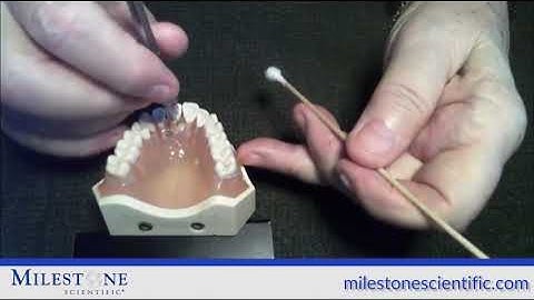 MLSS: P-ASA Injection with the STA System (Wand STA)