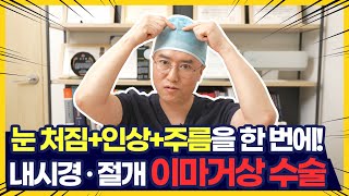 이마거상 수술에 대한 궁금증! 시원하게 풀어드립니다! #광주톱스타성형외과 #이마거상술