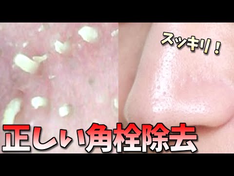 洗顔 後 毛穴 白い ポツポツ