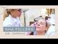 RHA Filler Before & After with Live Demonstration (Part 1)