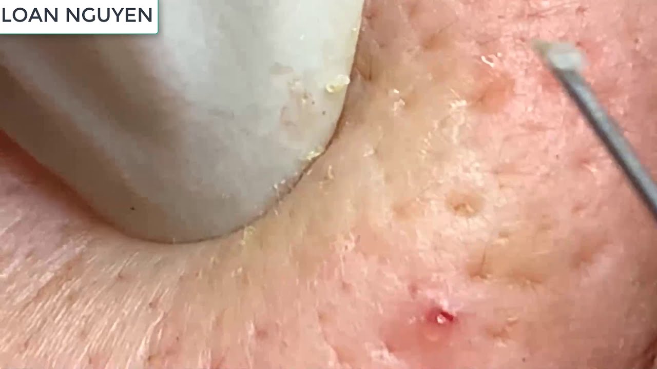 the return of blackheads and whiteheads