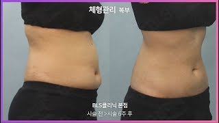 울핏 펀치웨이브 미쿨 체형관리 시술 영상 BLS클리닉 압구정점 압구정역 피부과, 비만클리닉