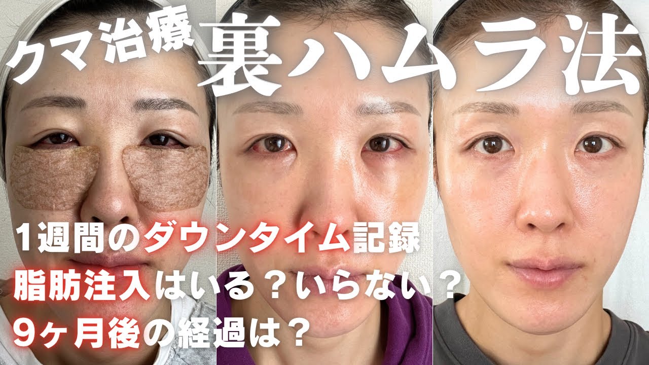 【裏ハムラのリアル👁️💥】８日間のダウンタイムの記録🌟脂肪注入は必要？9ヶ月後の今は？の結果は...