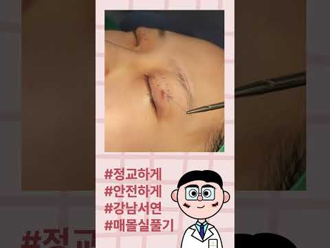 매몰실 풀기/매몰실 제거